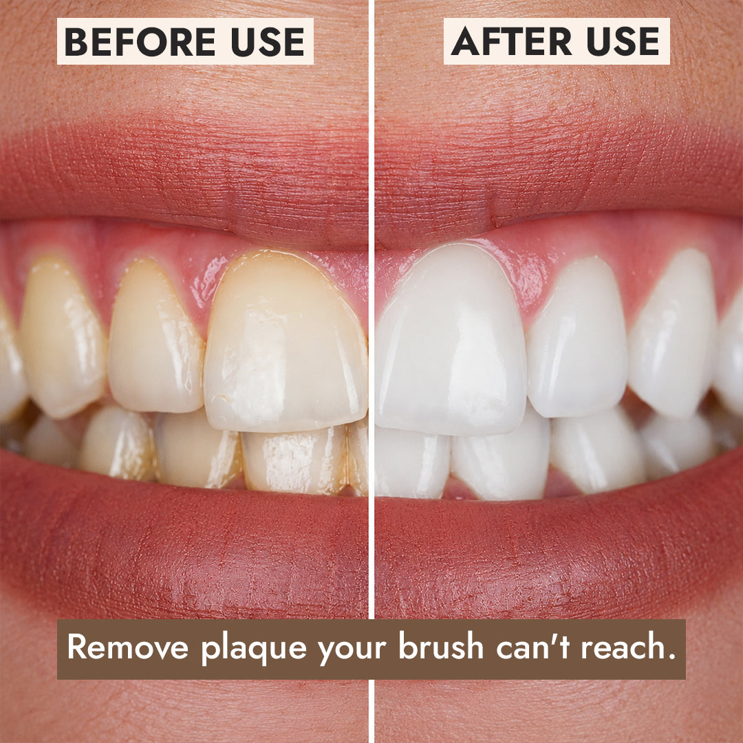 Pro Ultrasonic Plaque Remover