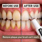 Pro Ultrasonic Plaque Remover